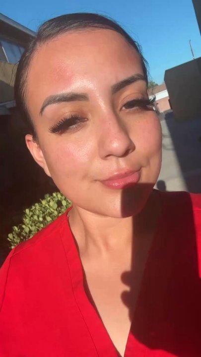 NakedMD - Post lips and radiesse filler on cheeks, filler on chin and smile likes. Absolutely love - Medical Spas Near Me - Downey, California