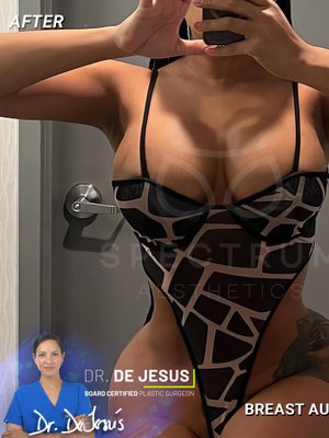 Breast Augmentation result at Spectrum Aesthetics