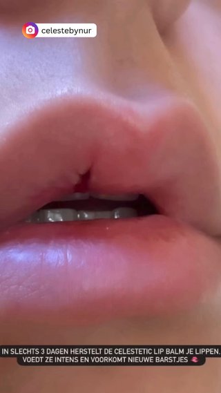Lip Filler - vidéo