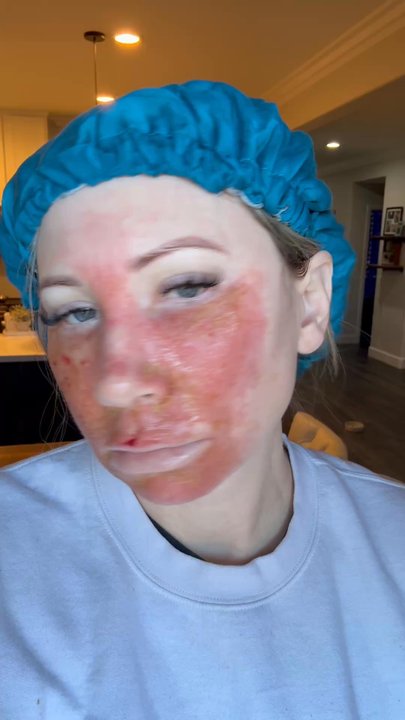 Salt & Light Wellness - Tail end of chemotherapy treatment to my entire face. - Saunas Near Me - Temecula, California