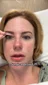 @dr_crentist, surgery day to day 4 after a brow lift alone