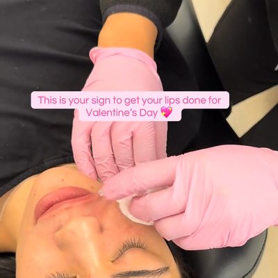 22 Plastic Surgery & Spa MD lip filler result — Cottonwood Heights, UT