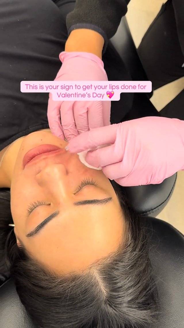 Lip Filler result at 22 Plastic Surgery & Spa MD