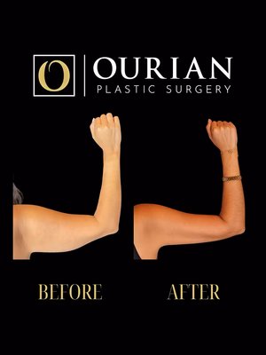 Liposuction result at Ourian Plastic Surgery