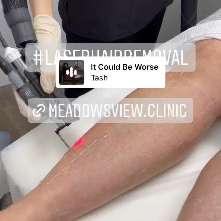 Meadows View Clinic - Painless Laser Hair Removal with state of the art Elite+ using Nd:YAG lase - Laser Hair Removal Near Me - Pitt Meadows, British Columbia