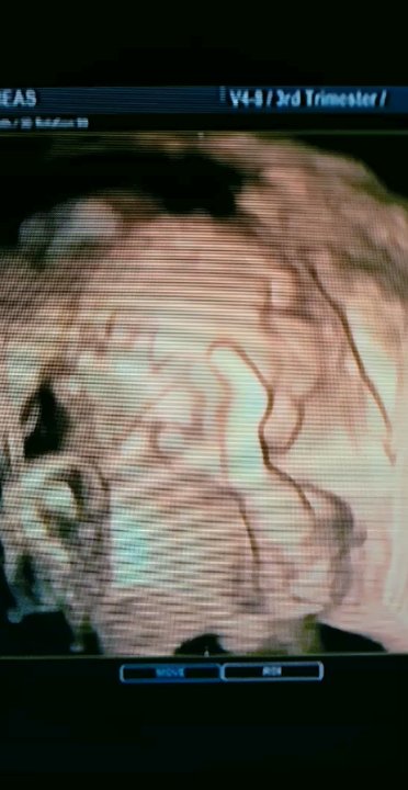 Womb's View - I took the video from the tv with my phone &it definitely did not show it as clear as you see it in person but you are still able to tell. - Ultrasound Imaging Centers Near Me - Modesto, California