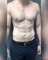 Dr. Mordcai Blau’s practice, an adult patient at six months after gynecomastia surgery