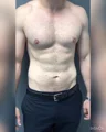 Dr. Mordcai Blau’s practice, an adult patient at six months after gynecomastia surgery