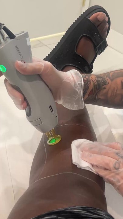 Semper Laser - Laser Hair Removal Near Me - Tampa, Florida