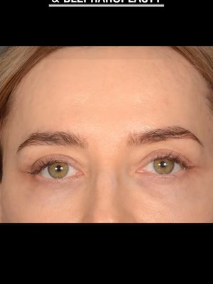 Blepharoplasty result at Dr. Rady Rahban