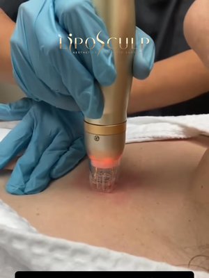 Microneedling result at LipoSculp