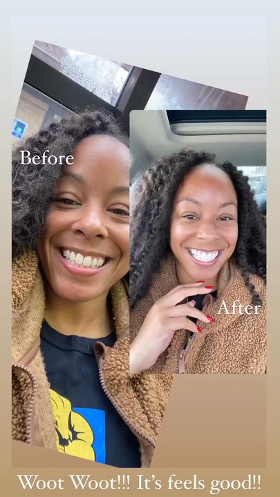The Smile Spa - Before and After! Amazing Results! - General Dentistry Near Me - Irving, Texas