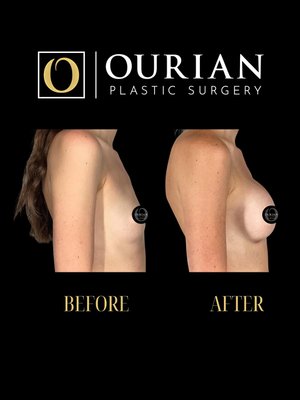 Breast Augmentation result at Ourian Plastic Surgery
