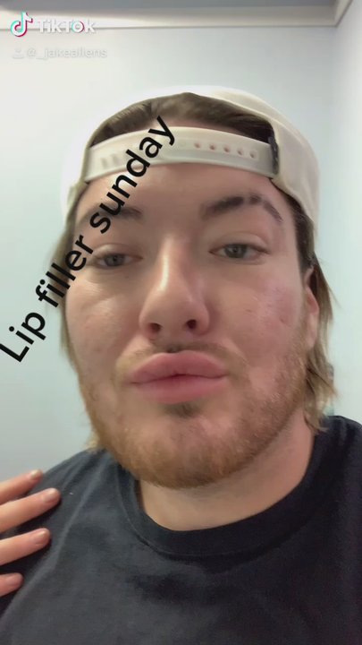 The Shop - Needless lip fillers done by Jake - Hair Salons Near Me - Milan, Michigan