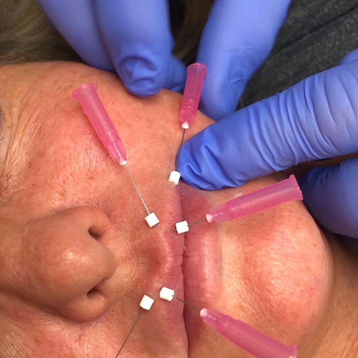 Skin Retouch MediSpa - Stop those nasty lines around your lips help restore collagen by doing smooth threads. - Medical Spas Near Me - Newark, Ohio