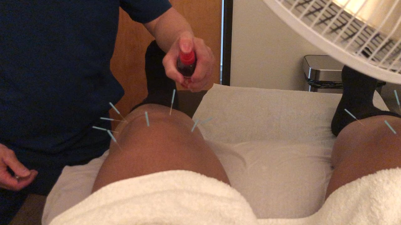 Fong Acupuncture - Acupuncture Near Me - Pasadena, California