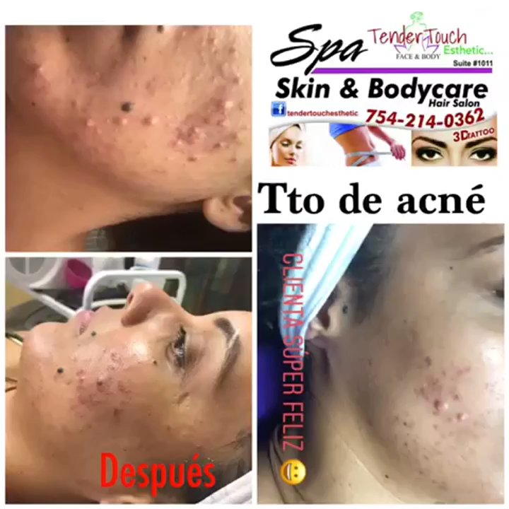 TenderTouch Esthetic - Tratamiento de acné - Skin Care Near Me - Altamonte Springs, Florida