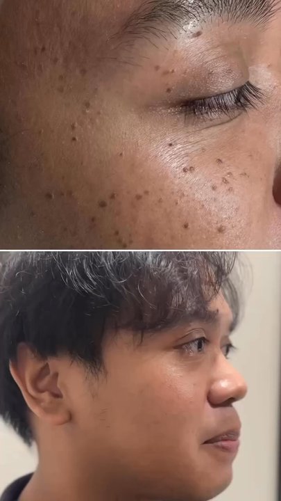 Faces and Lashes - Flat warts removal - Skin Care Near Me - Rancho Cucamonga, California