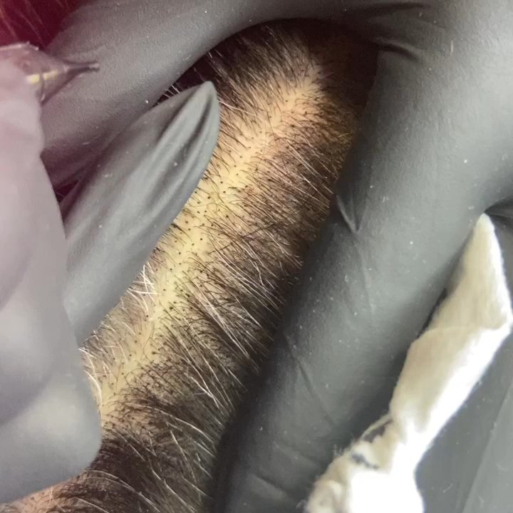 Scalp Prodigy - Scalp Micropigmentation for density to a part line. - Hair Loss Centers Near Me - San Jose, California