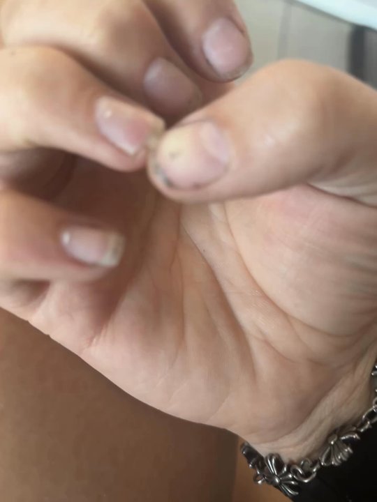 Angel Nails - Damaged nails from over filing - Nail Salons Near Me - Woodland, California