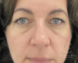 Combo Blepharoplasty & Lower Eyelid CO₂ resurfacing  Patient Image #1