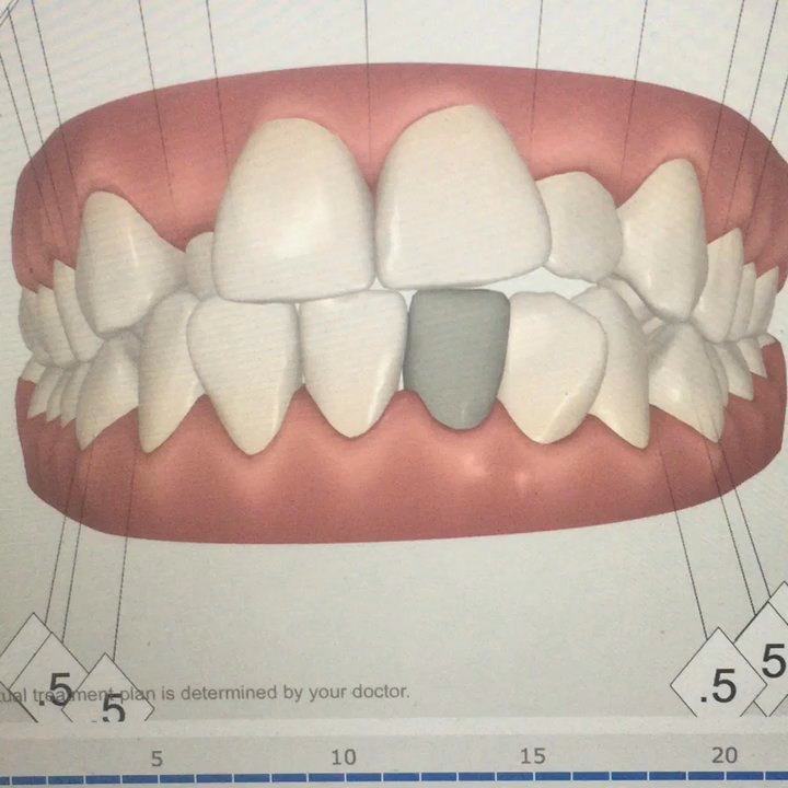 Korne Ortho - My video of how my teeth changed! - Orthodontists Near Me - Montreal, Quebec
