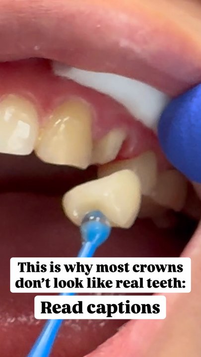 Marta Rudat, DDS - Crown to match the teeth next to it - General Dentistry Near Me - Tustin, California