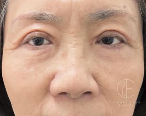 Asian Eyelids Blepharoplasty Patient Image #1
