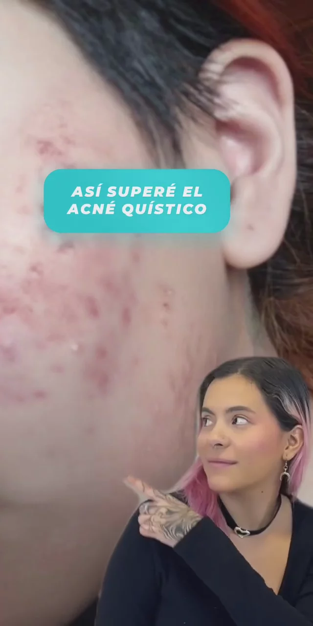 Testimonio Kit Antiacné
