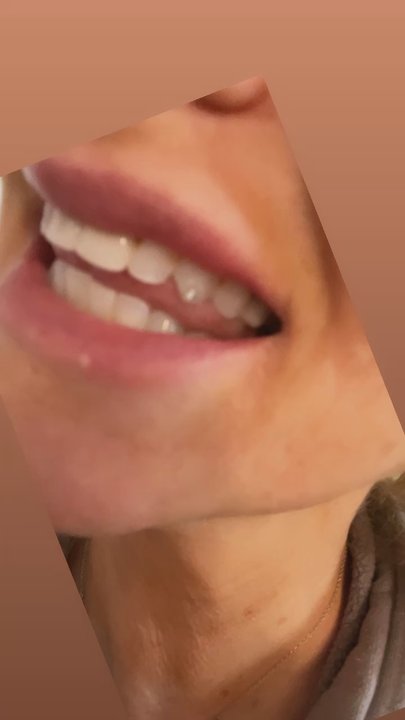 There She Glows - Tooth Gems - Teeth Whitening Near Me - Pinole, California