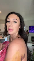 @oliviaannkaiser, day 5 after arm liposuction