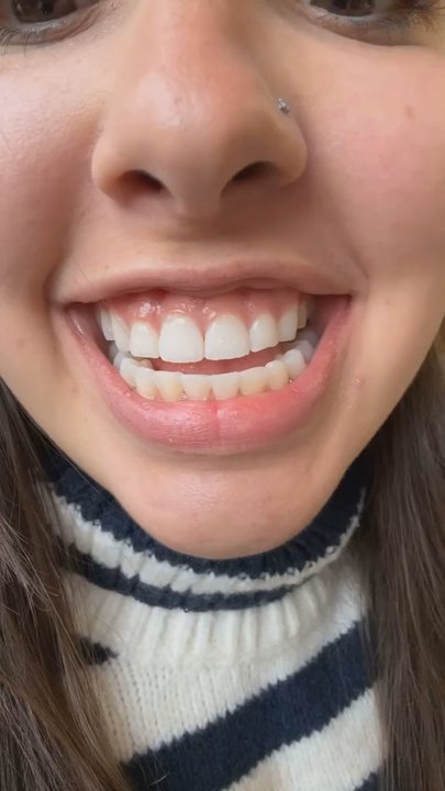 Michael Colleran DDS - After Invisalign - Cosmetic Dentists Near Me - San Luis Obispo, California
