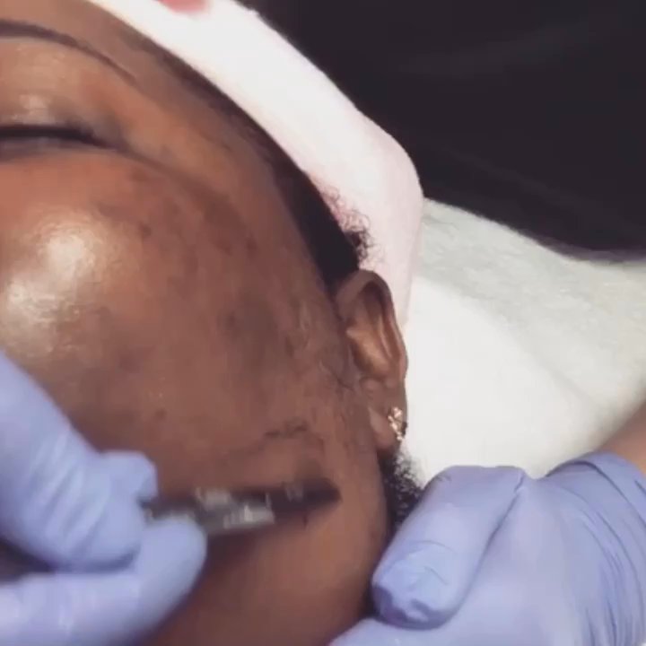 Skinpolitan - Dermaplaning Exfoliation Procedure - Skin Care Near Me - Las Vegas, Nevada