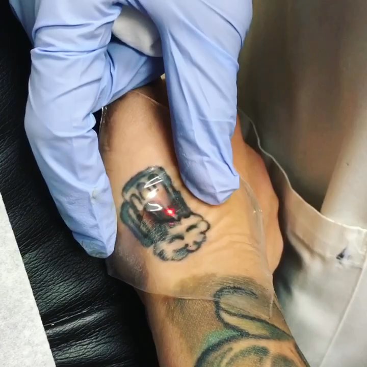 Renee Patel, MD - First session on removing this tattoo.  Had two sessions done so far, and it's significantly lighter. Super happy with the progress! - Laser Hair Removal Near Me - Downey, California