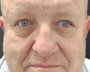 Male Upper Eyelid Surgery Patient Image #1