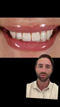 A clinician explains bonding and porcelain choices