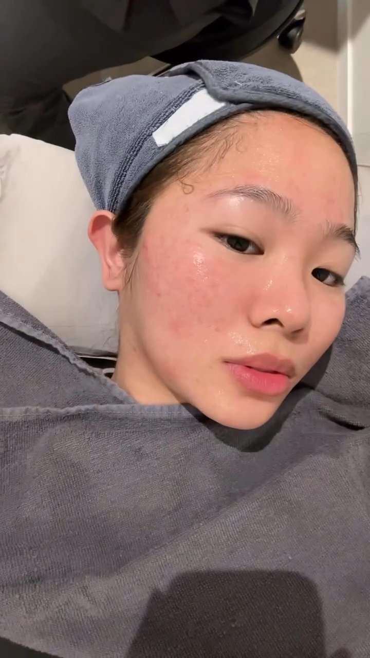 Chelsje Alquinto — Treatment Review at Seoul SY Dermatology