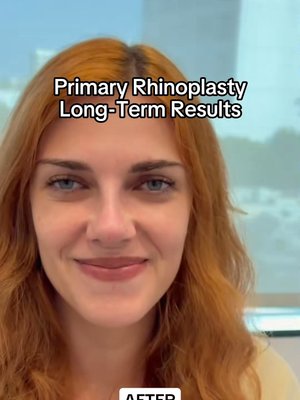 Rhinoplasty result at Eos Rejuvenation