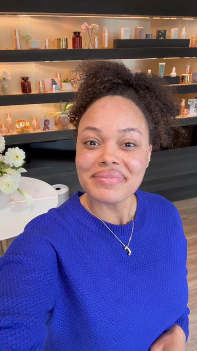 Tone Dermatology - Skin immediately after treatment! - Dermatologists Near Me - Chicago, Illinois