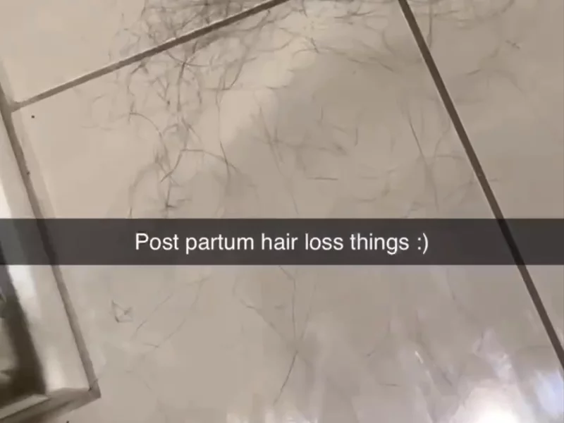 Post partum hair loss