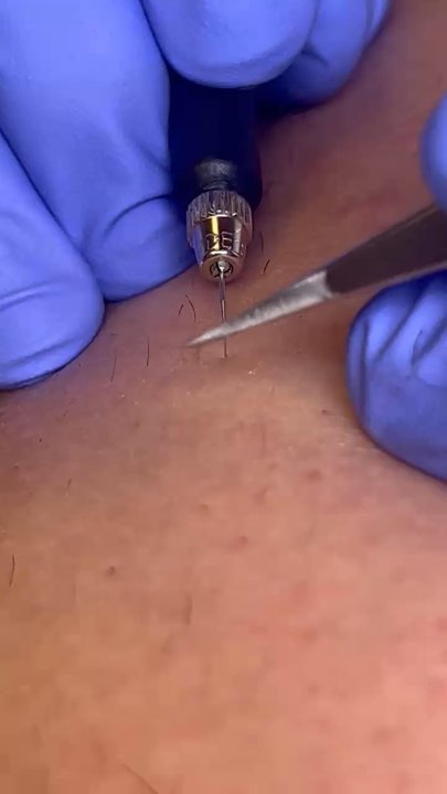 Exact Electrology - Hair Removal Near Me - Hillsboro, Oregon