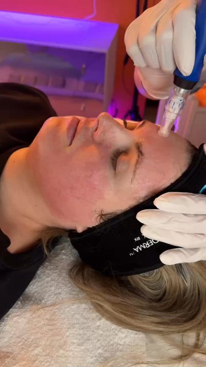 Foxy Laser - Microneedling helps build collagen and elastin in the skin. - Medical Spas Near Me - Denver, Colorado