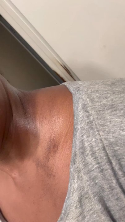 Goodman Dermatology - Rash on my neck/collarbone area - Dermatologists Near Me - Roswell, Georgia