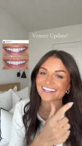 @burghandy.anne on adjustments after final veneers