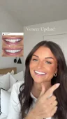 @burghandy.anne on adjustments after final veneers