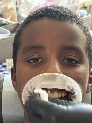 Veneers result at Thomas Dental