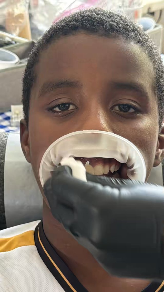 Veneers result at Thomas Dental