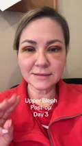 @glowbysallye, day 3 after upper blepharoplasty