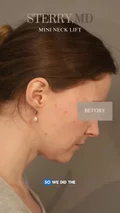 @therealdrsterry on who isn’t a neck liposuction candidate