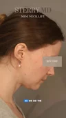 @therealdrsterry on who isn’t a neck liposuction candidate